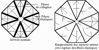 Emphysème (centro-lobulaire,paraseptal,paracicatriciel ,pan-lobulaire ) Bpcoem10