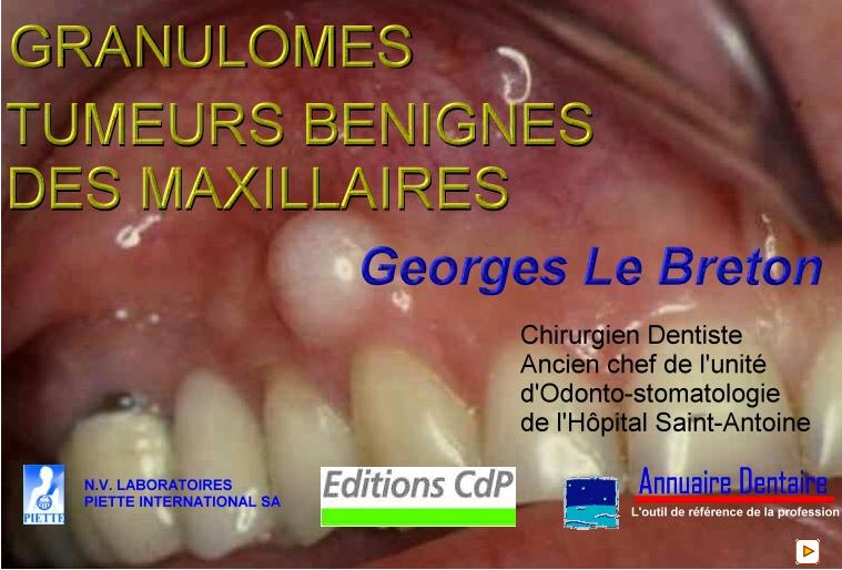 Granulomes-Tumeurs bénignes des maxillaires Gr10
