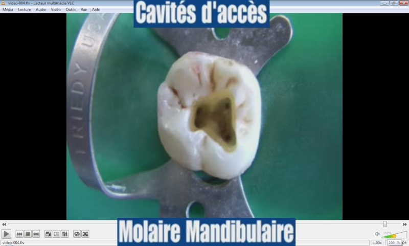  Cavité d'accés : Molaire mandibulaire (vidéos) Mand10