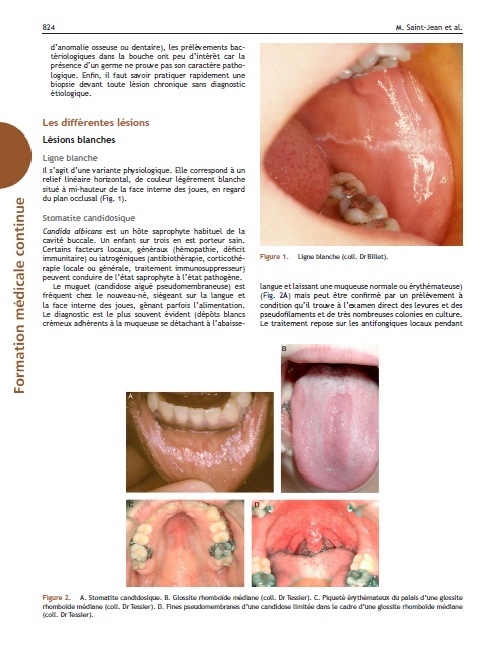 Pathologie buccale de l'enfant Pa10