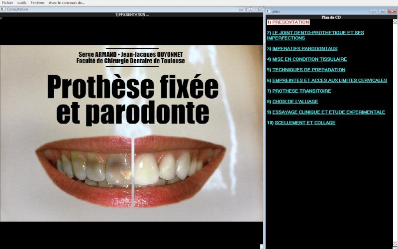 Prothèse fixée et Parodonte (CD-ROM) Sans_t43
