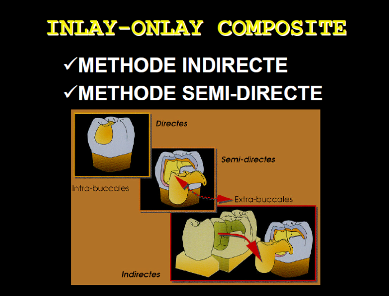 Inlay-onlay Composite Sans_t10
