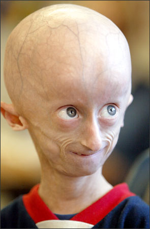 Progeria 41319710