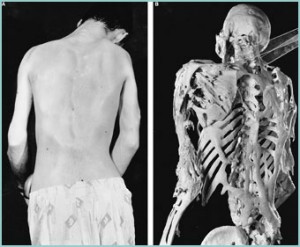 La Fibrodysplasia Fibro-10