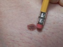 Worried about melanoma (PICS) Mole210