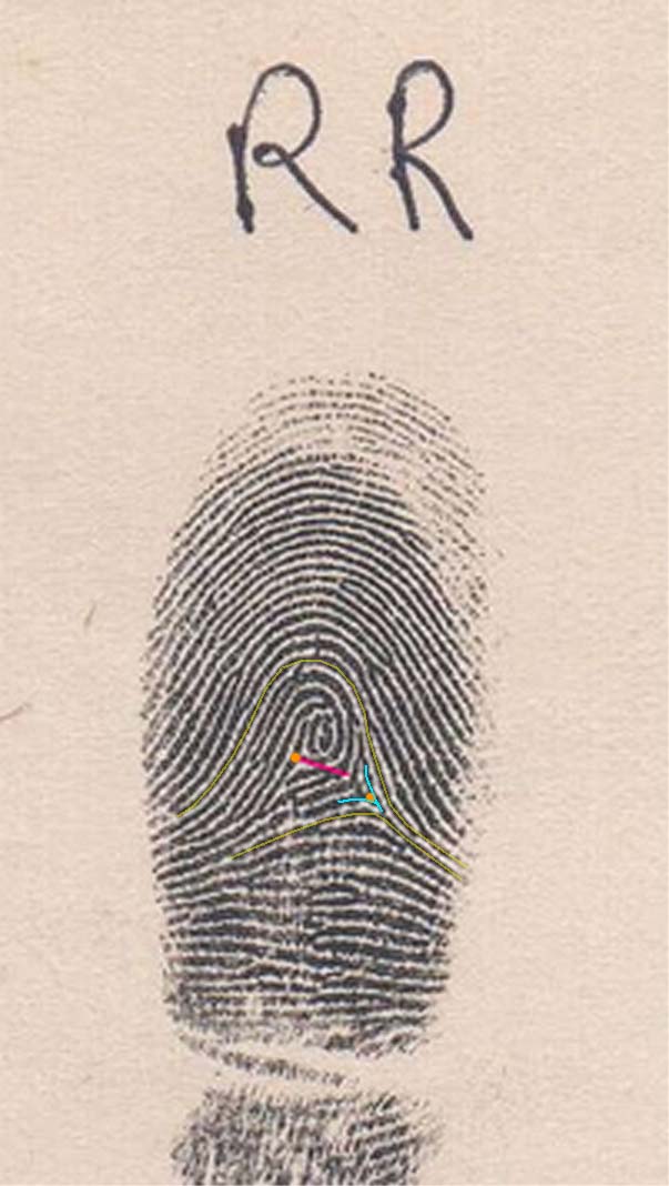 What sort of fingerprint is there on RR finger?  Parend11