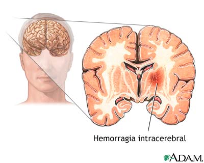 *Sistema Nervioso*-Hemorragia intracraneal. 881310