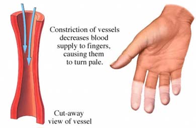 * El Sndrome de Raynaud (manos fras)* Getima10