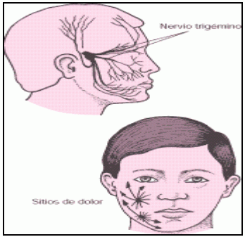 *Sistema Nervioso*-Neuralgia del Trigmino. Tro210