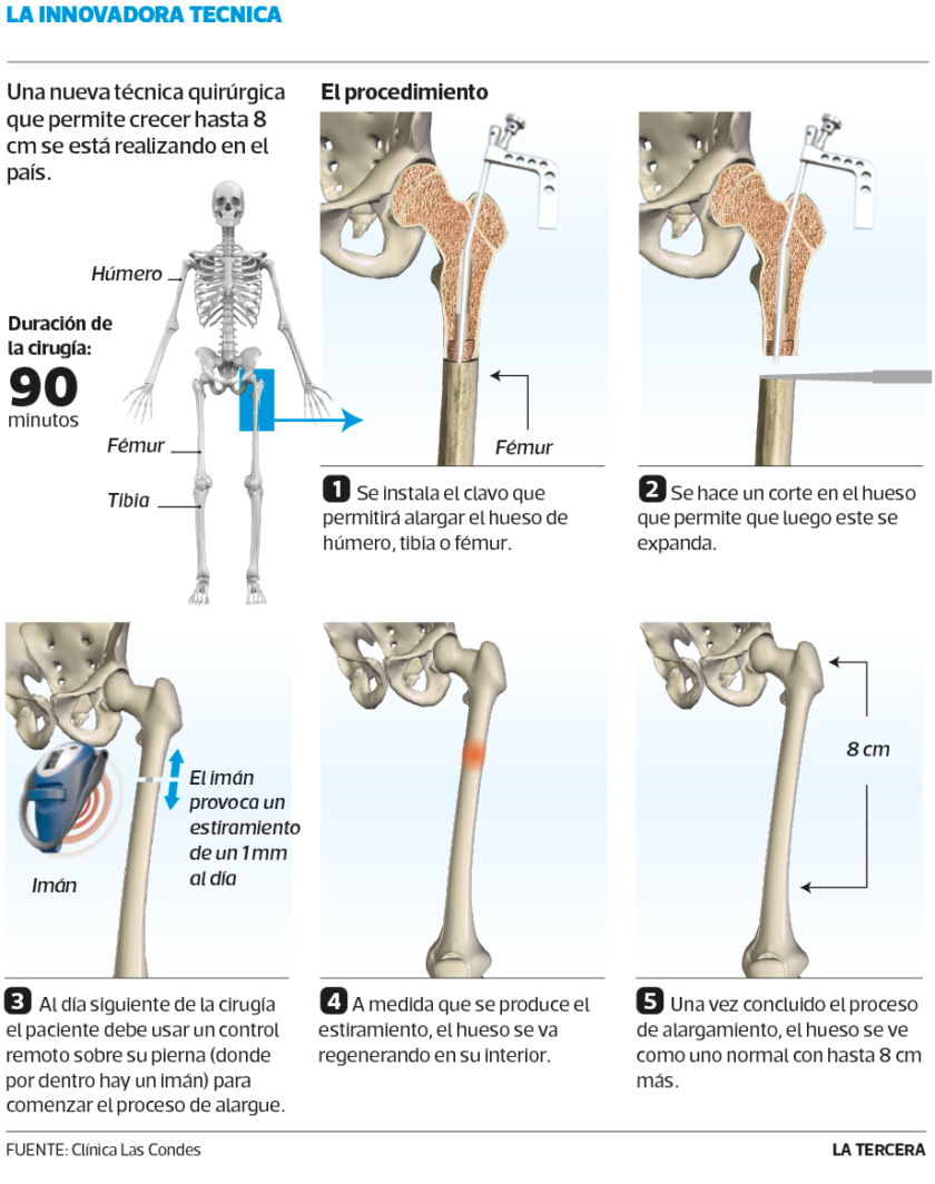 Clavo PRECICE - (alargamiento de huesos para ganar estatura) - España / América Latina - Página 12 16010010
