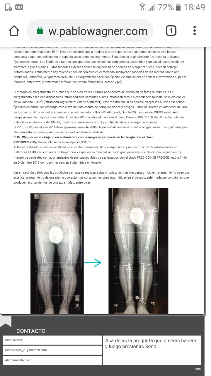 Clavo PRECICE - (alargamiento de huesos para ganar estatura) - España / América Latina - Página 21 Screen15