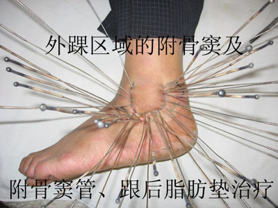 Picture of silver needle warming therapy in China,Looks horrorble! Ankel10