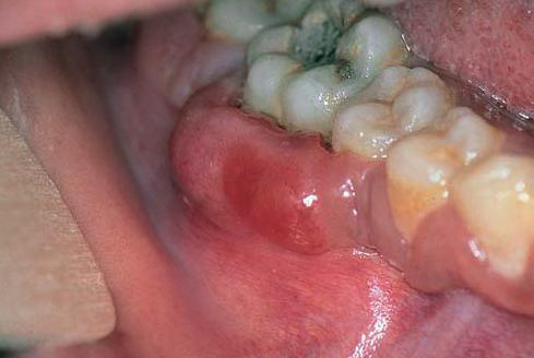 A Note on Bone Swellings in Jaw Bones Burkit11