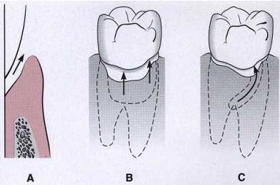 PERIODONTAL POCKET Classi10