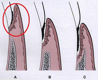 PERIODONTAL POCKET Gingiv10