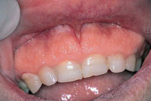 A Note on Bone Swellings in Jaw Bones Paget_10