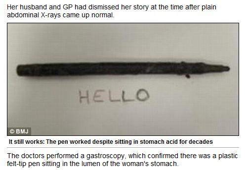 Elle vivait depuis 25 ans avec un stylo dans l'estomac  H-1-2628