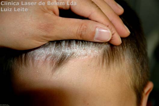 Doentes com Psorase: at 79% podero ser afectados no couro cabeludo Info_p10