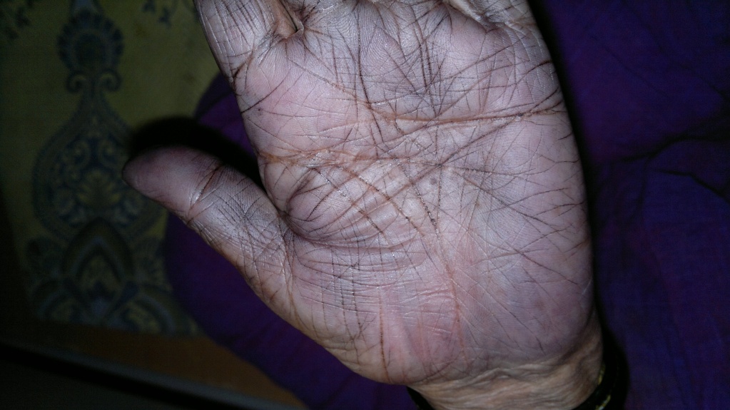 The Hands of Alzheimer's Patient 08042012