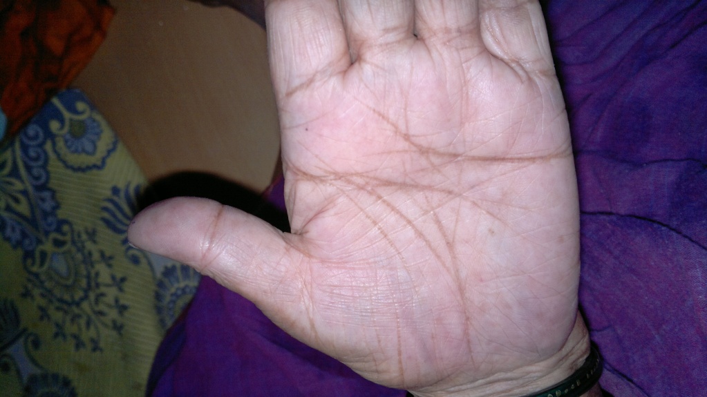 The Hands of Alzheimer's Patient 08042015