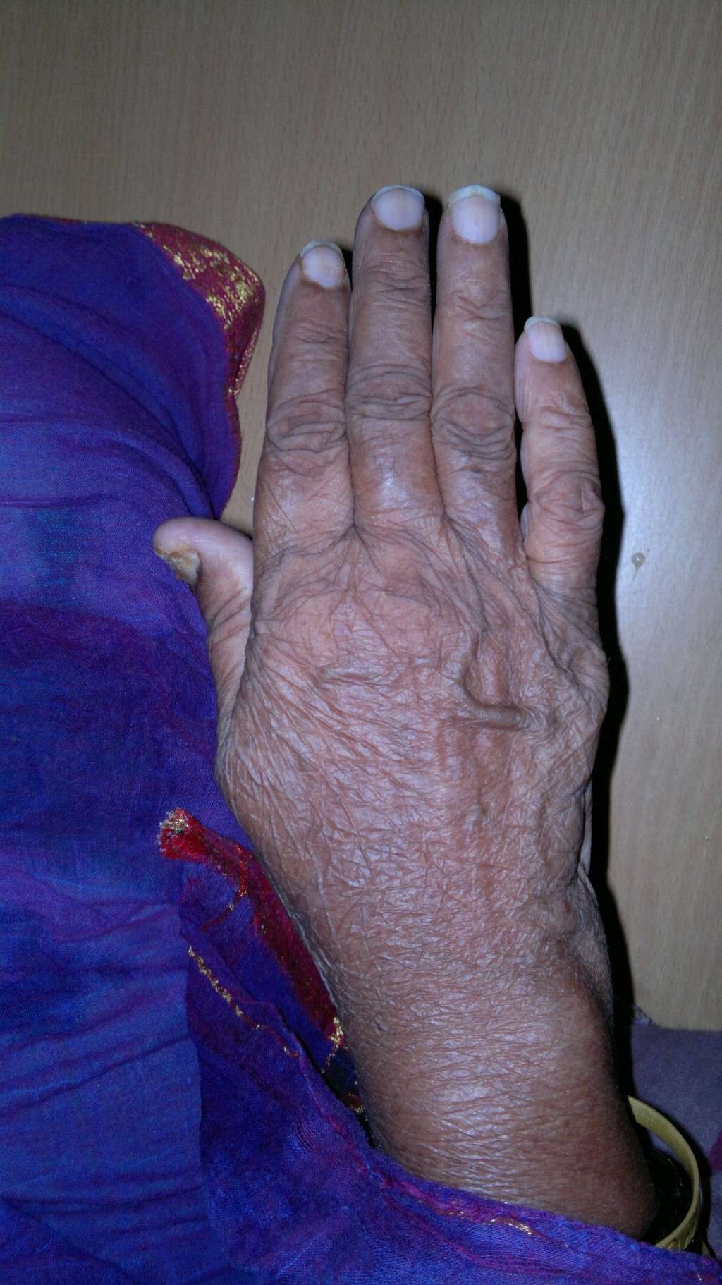 The Hands of Alzheimer's Patient 08042016