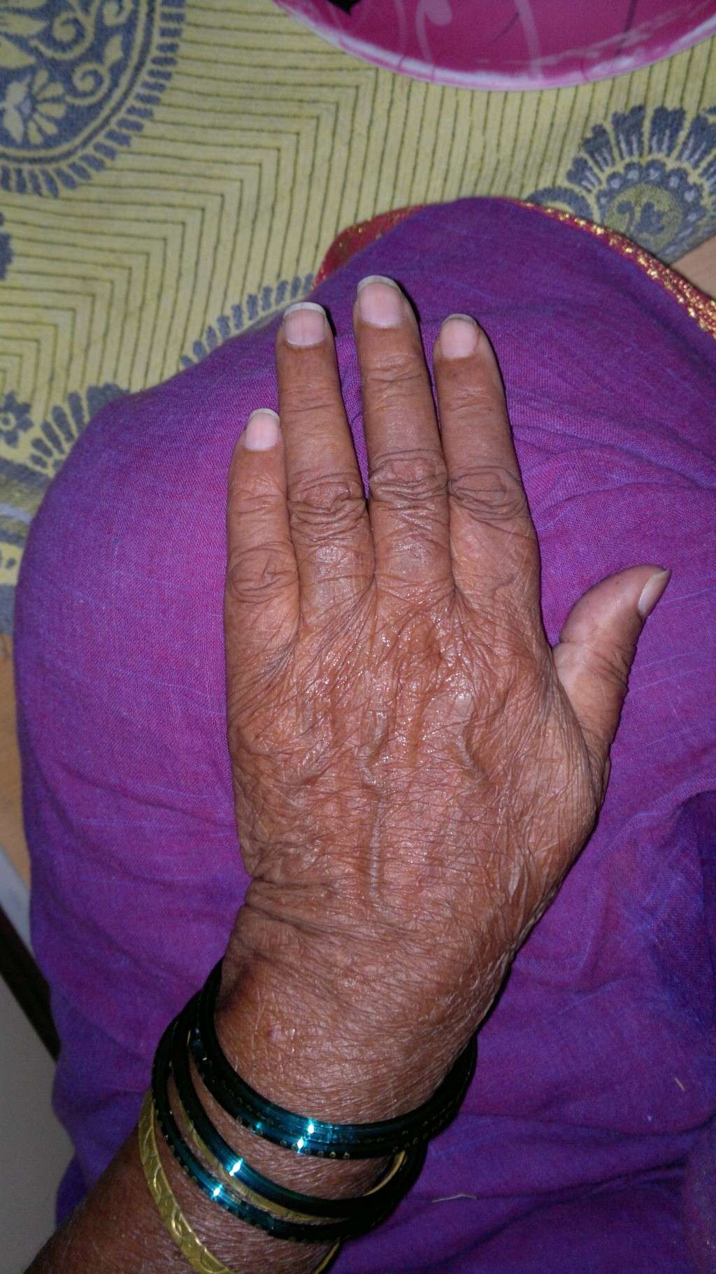 The Hands of Alzheimer's Patient 08042017