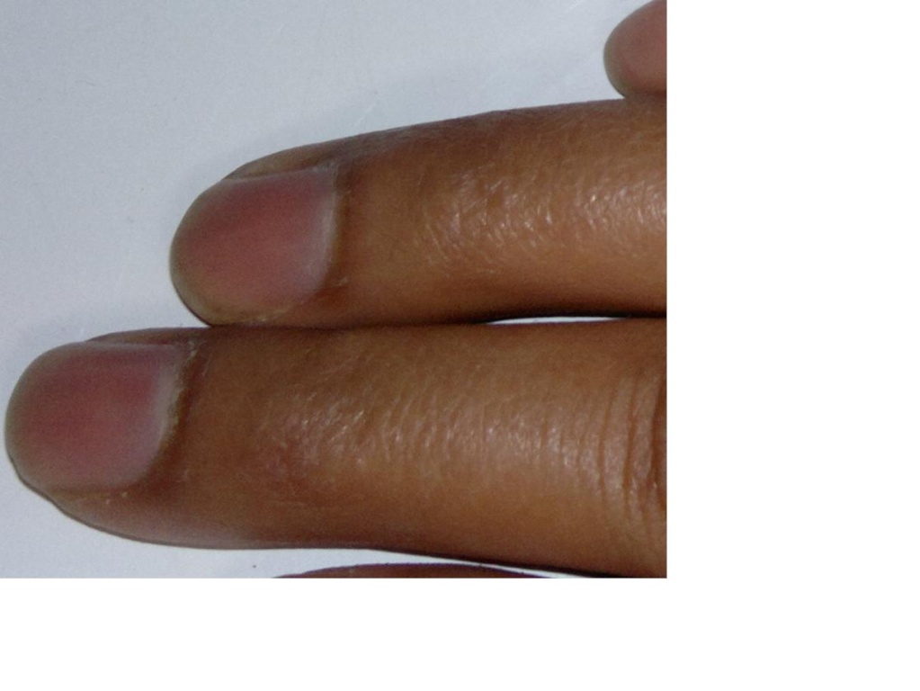 Missing Crease between 1st and 2nd Phalange on Apollo Above_10