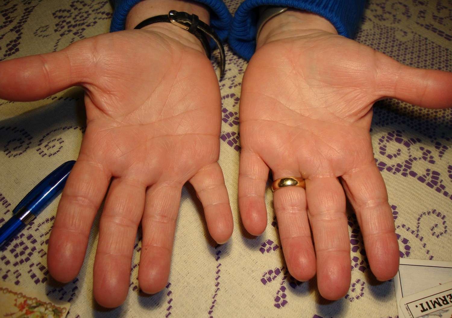 Hand Manifestations of Diabetes Mellitus - Page 2 Dsc08812