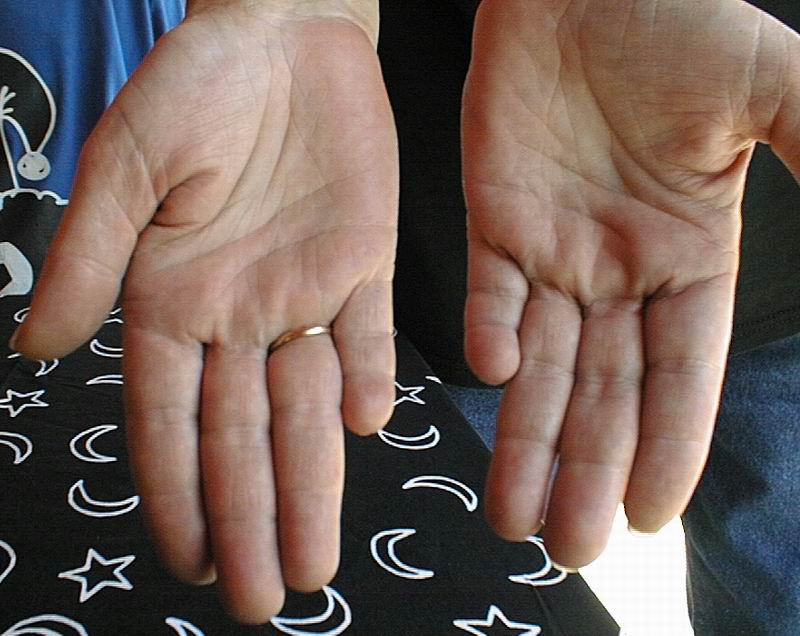 Low set finger (mercury finger) and meaning Little10