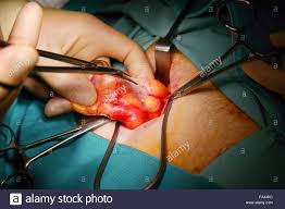 hernia repair surgery Downlo11