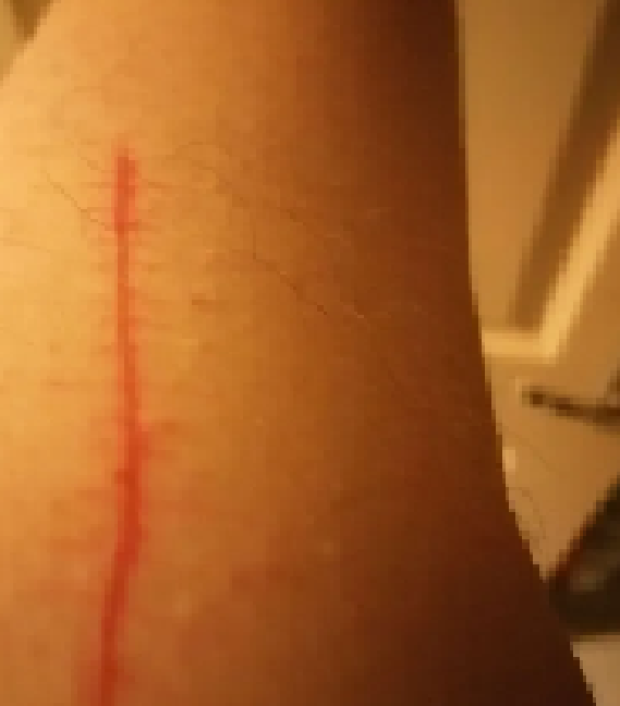 weird scar on my arm Image12