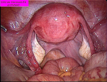 utérus, vagin et péritoine  Coelio10