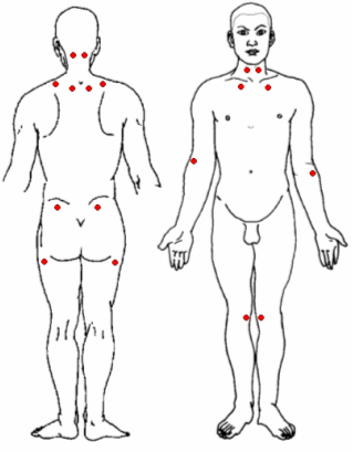 El Sndrome de Fibromialgia, un Enfoque Alternativo Fibrom10