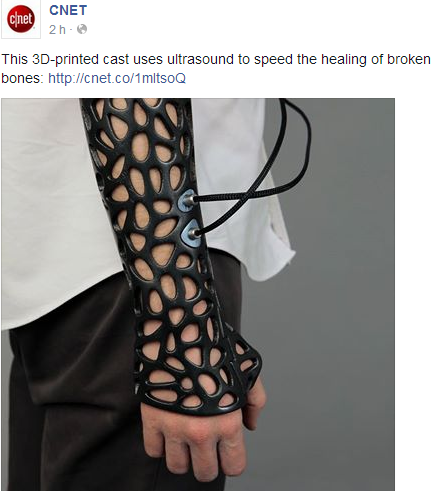 3D-printed cast uses ultrasound to speed healing Temp2150