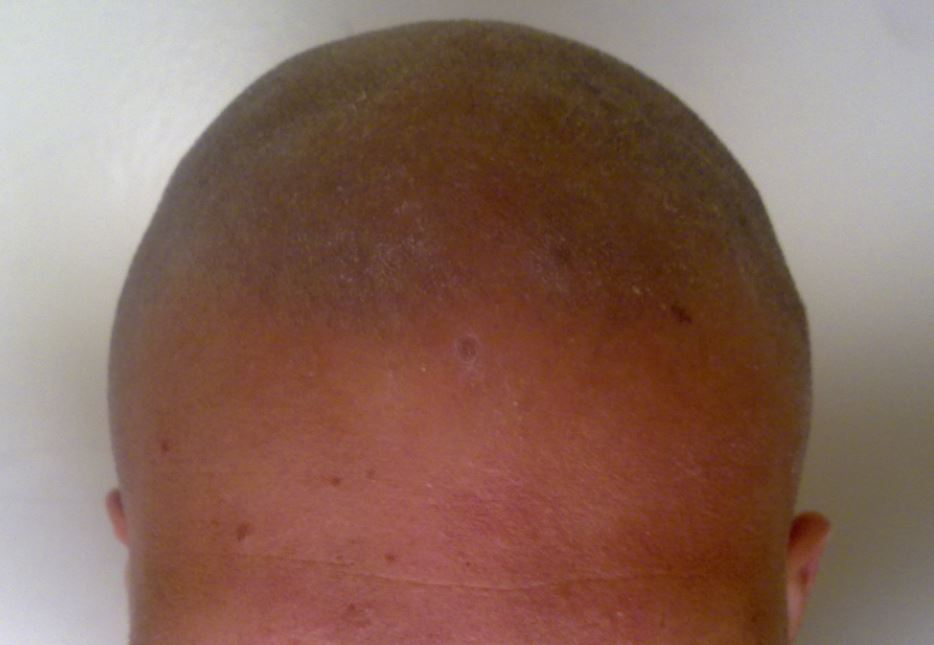Scalp peeling with 20% glycolic acid: GREAT RESULTS... - Page 7 Pelada10