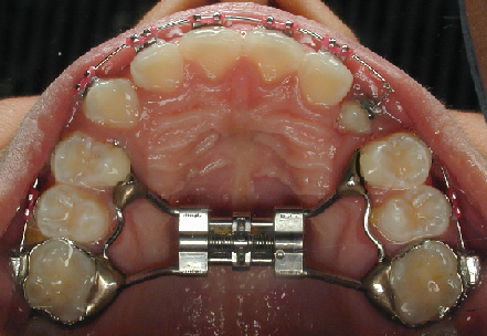 BRACKETS DE TORTURA - Página 5 Quo13