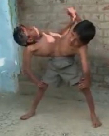 صورة وفيديو: توأمان هنديان ملتصقان بجسدين وعلى ساقين اثنين فقط Hind10