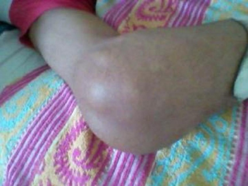 الهيموفيليا ( haemophilia ) 833