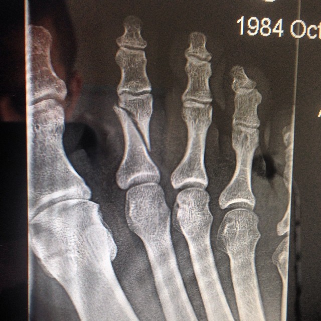 Bisping asked for Rockhold, Rockhold says no i injured my pinky toe Broken10