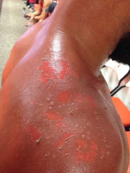 Hendricks suffered second-degree burn while filming UFC 167 commercial Img_9510