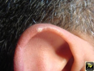 Nodule douloureux de l'oreille: traitement naturel possible? 89bf5510