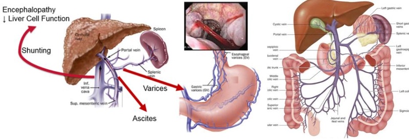 Cirrhosis High Yield 123