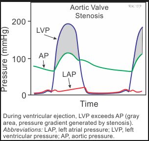 Heart Murmur Aortic10