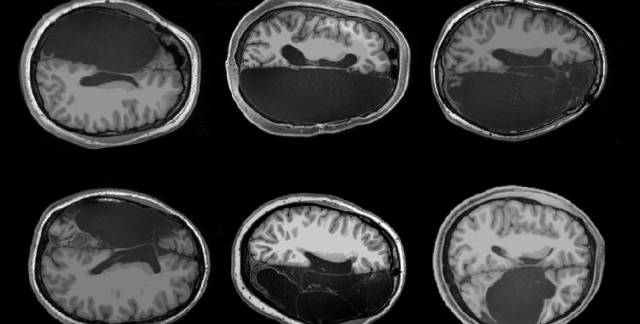 Cerebro,  neurociencia. Estudio  histórico sobre maduración  y crecimiento cerebral. - Página 2 15741710