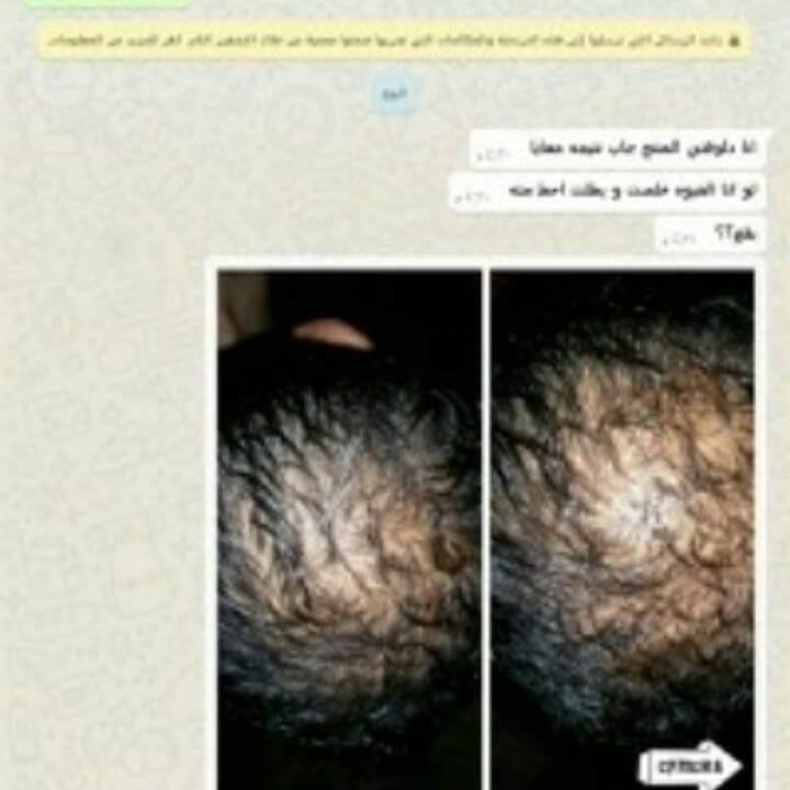 علاج تساقط شعر في مصر 17238611