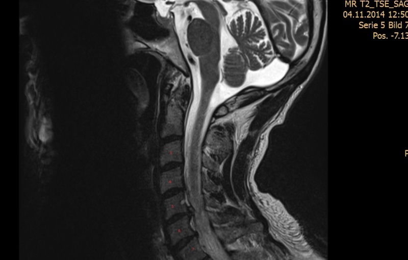 Bandscheibenvorfall HWS - Eisensportler mit Erfahrungen? Mrt311