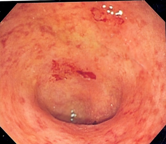 Enfermedad de Crohn Ucgran10