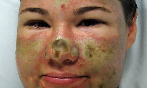 a woman from Washington, was “attacked” with acid by an African American woman, or so she claims Acid-p10