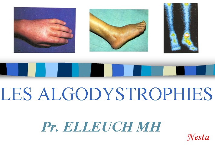 Algodystrophies.... 110