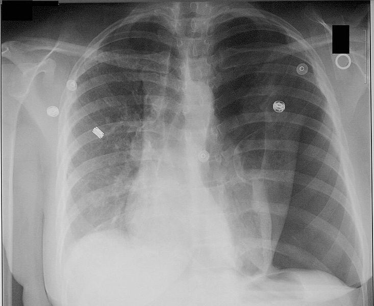 Two forgotten signs in pneumothorax 733px-10